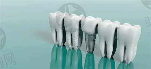 金华永康浙爱口腔秦鹏医生 士诺康种植牙2999元起，高难度种牙也能做